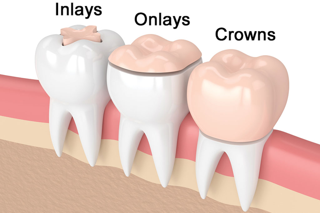 Inlays-and-Onlays.jpg