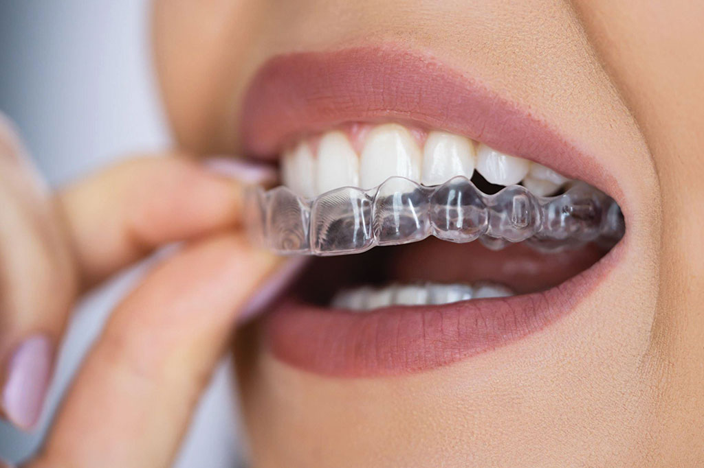 Invisalign-Braces.jpg