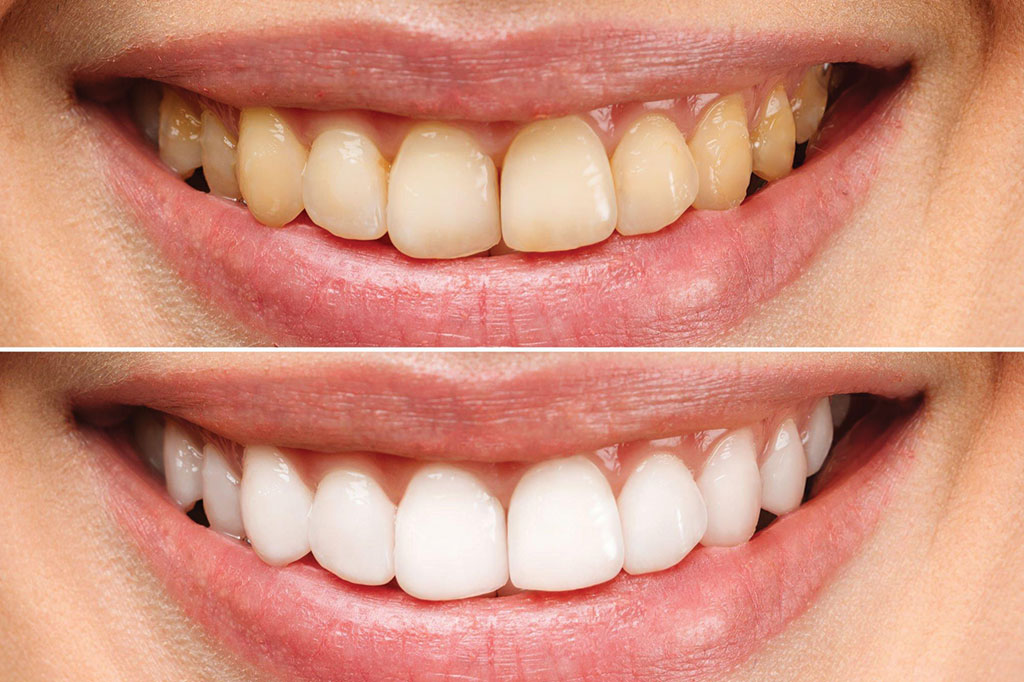 Tooth-Whitening.jpg